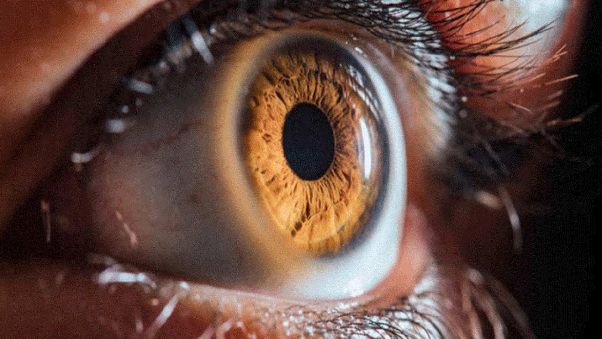 Ο πρώτος 3D-εκτυπωμένος κερατοειδής στον κόσμο αποκαθιστά πλήρως την όραση ασθενούς